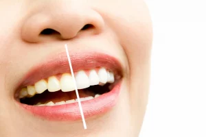 Blanchiment dentaire Chevry dentiste